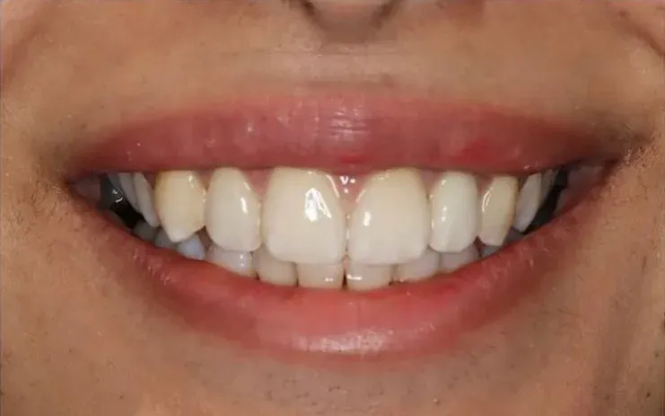 After: Anterior Crowns