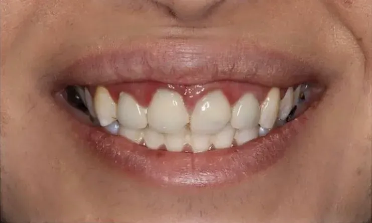 Before: Anterior Crowns