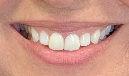 After: Anterior Veneers — Case 2