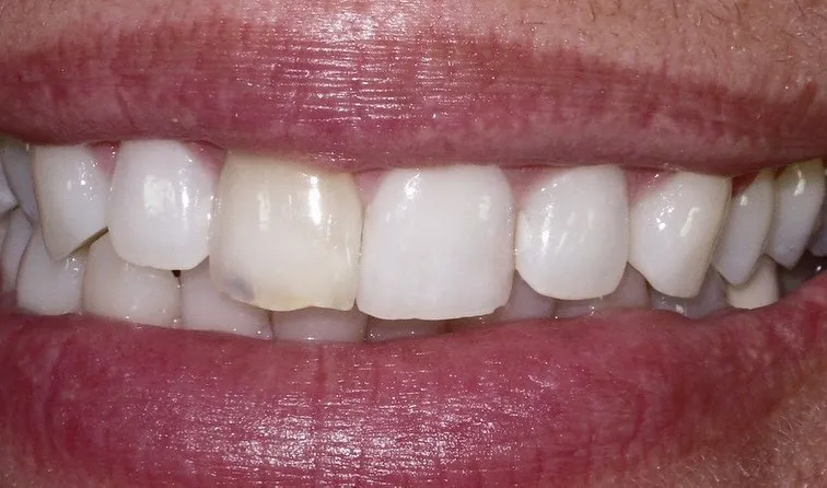 Before: Anterior Veneers — Case 2