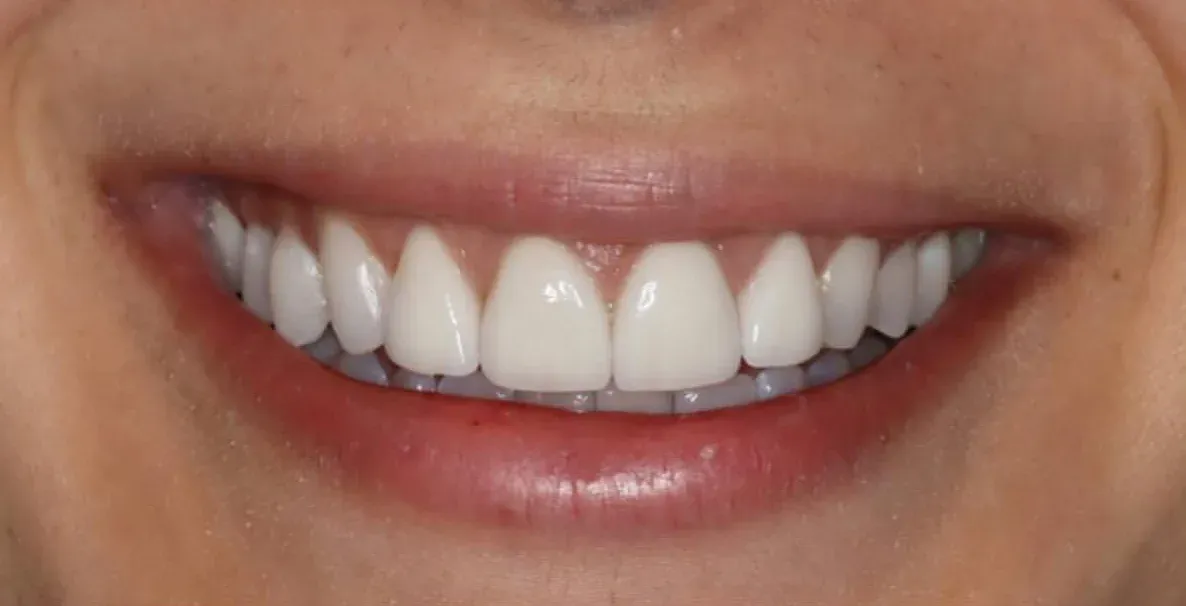 After: Anterior Veneers