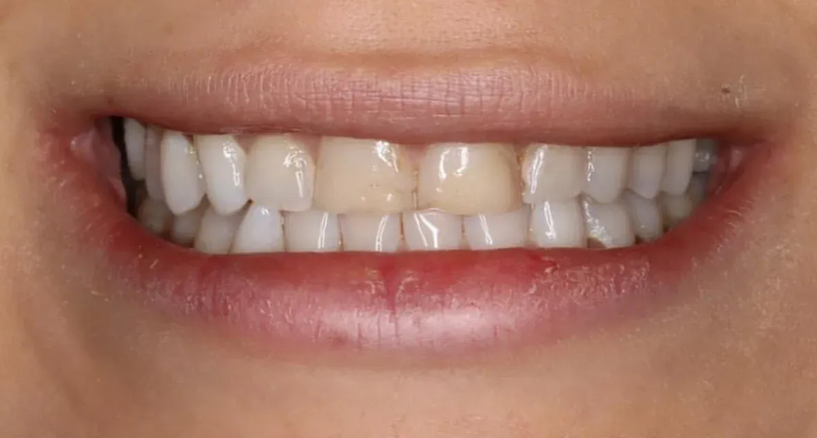 Before: Anterior Veneers