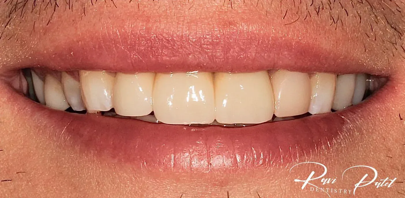 After: Central Incisor Bridge