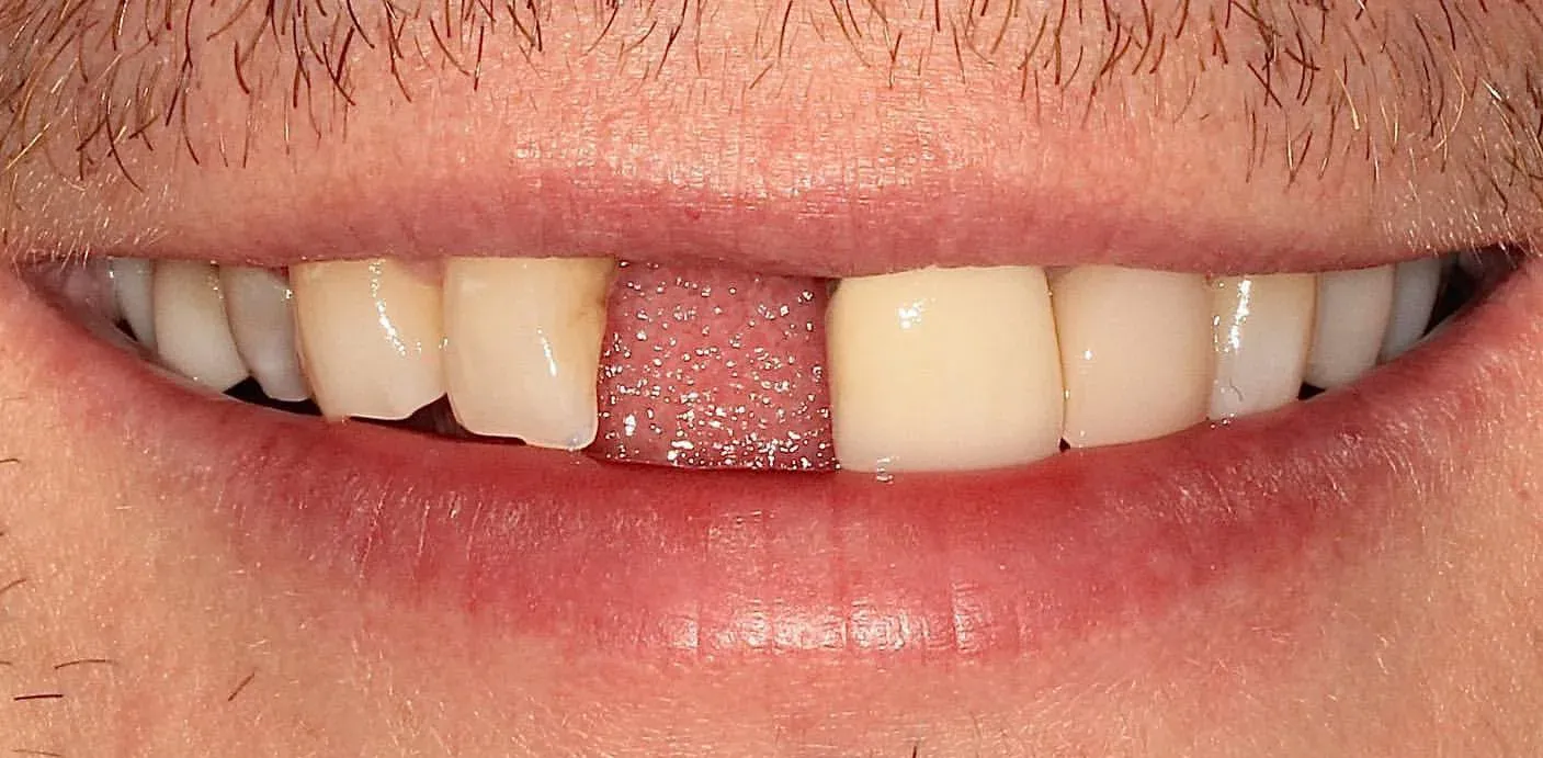 Before: Central Incisor Bridge