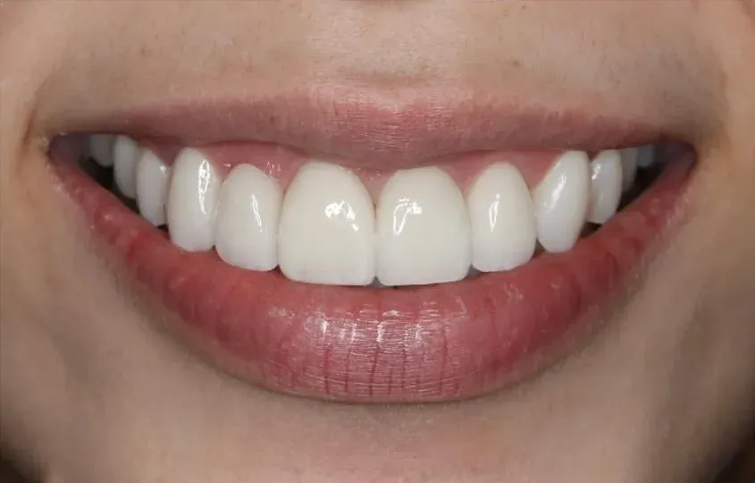After: Crown, Bridge & Veneers