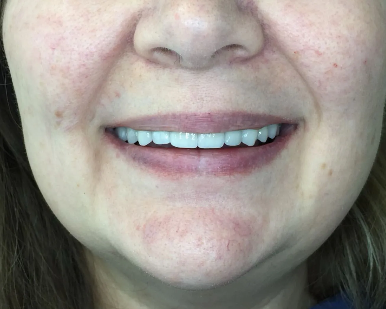 After: Full Mouth Rehabilitation