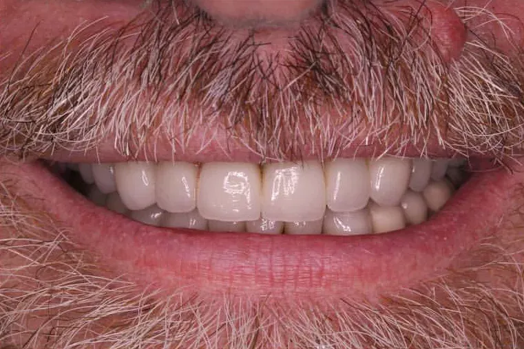 After: Mouth Rehabilitation