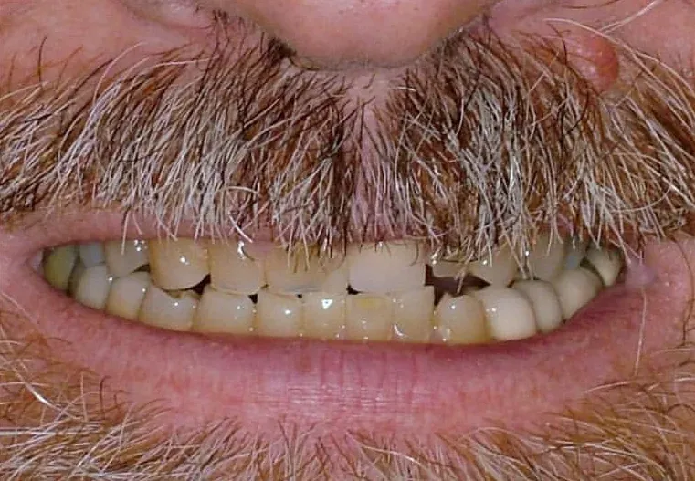 Before: Mouth Rehabilitation