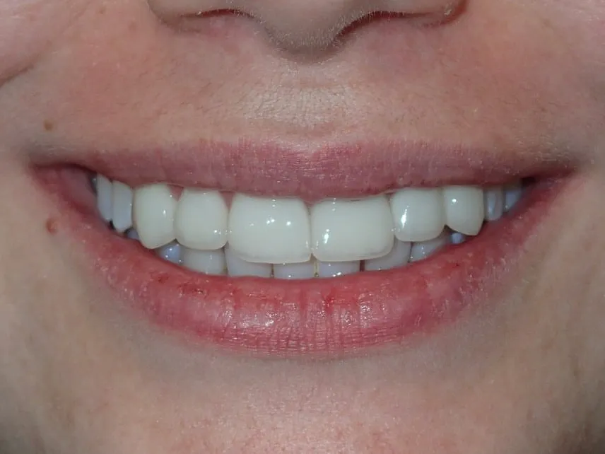 After: Implant & Five Veneers