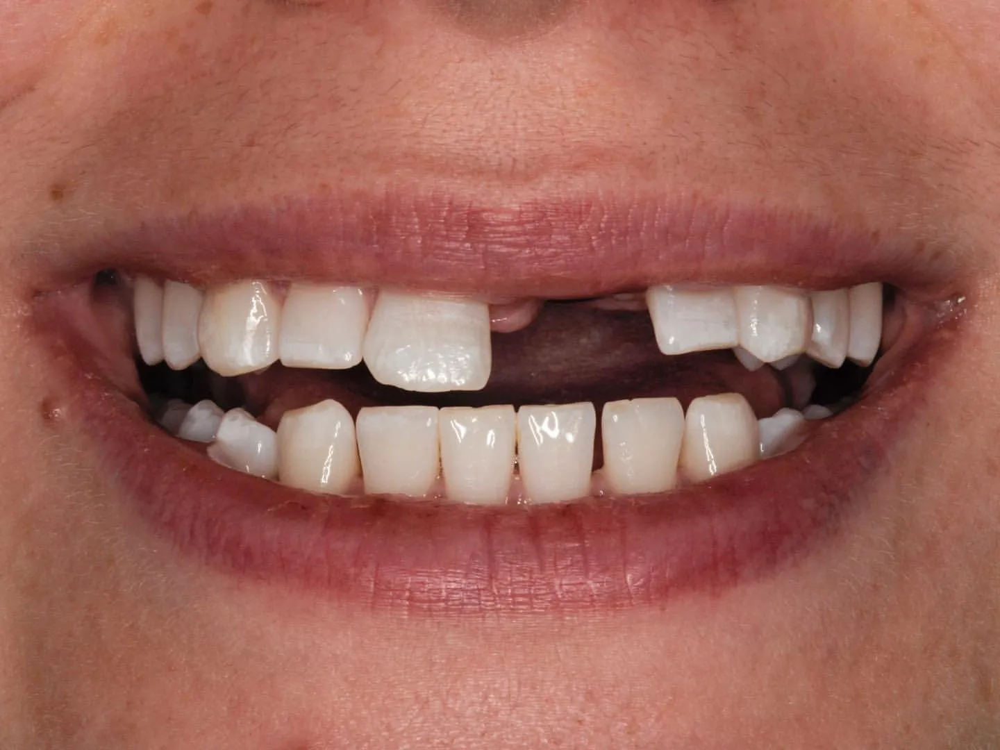 Before: Implant & Five Veneers