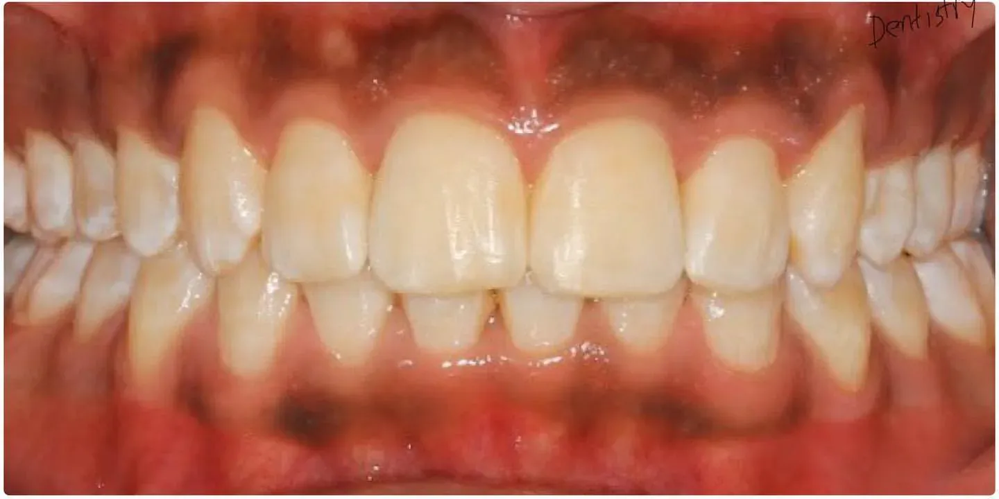 After: Invisalign Aligners