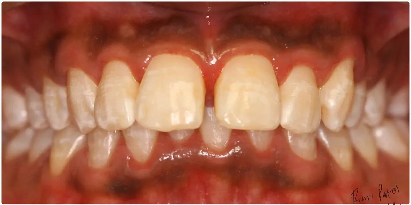 Before: Invisalign Aligners