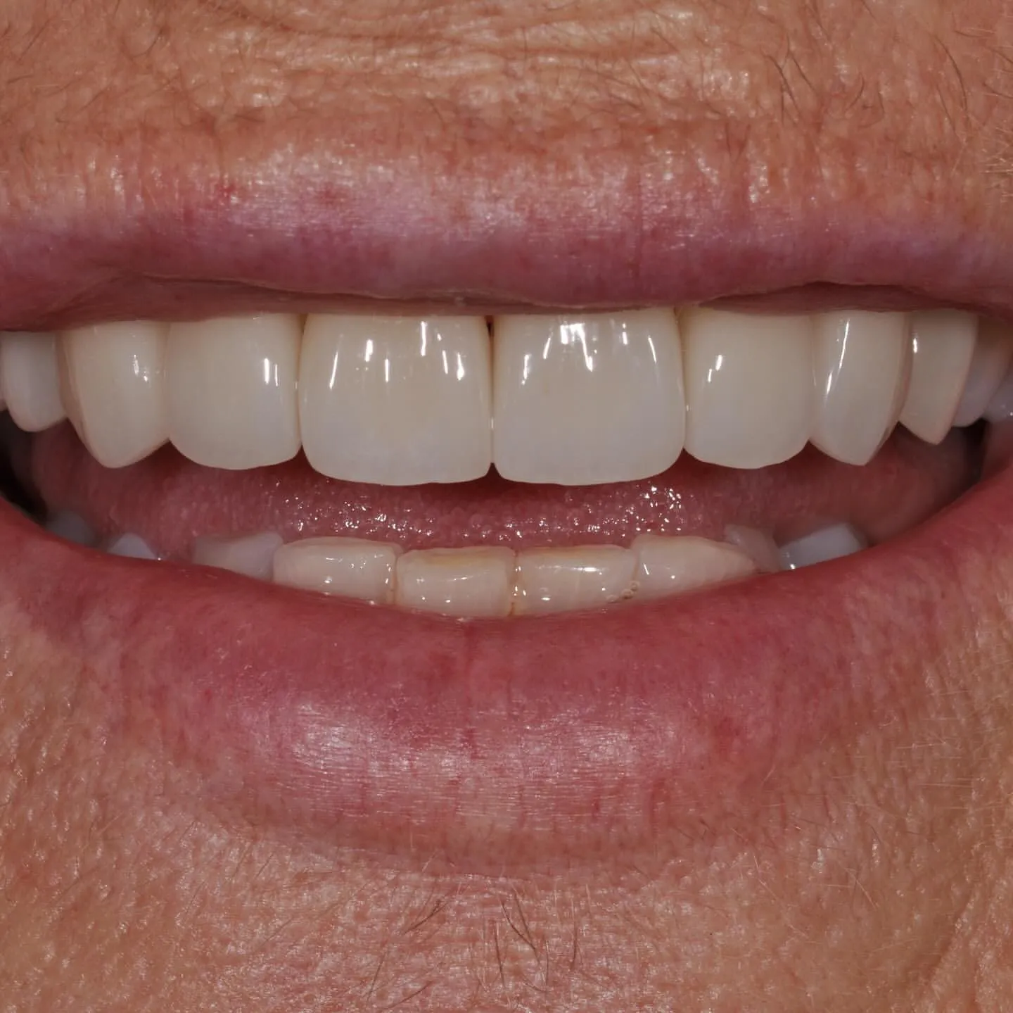After: Anterior Veneers