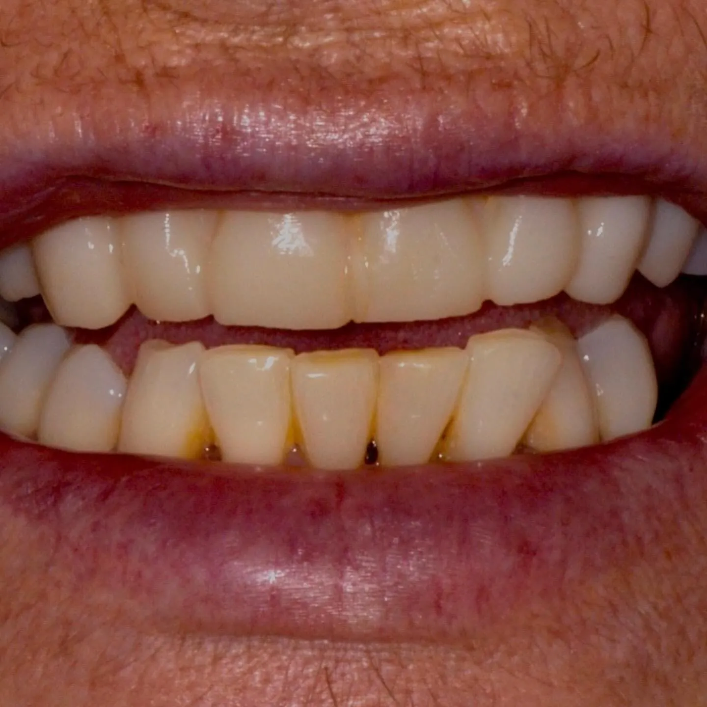 Before: Anterior Veneers